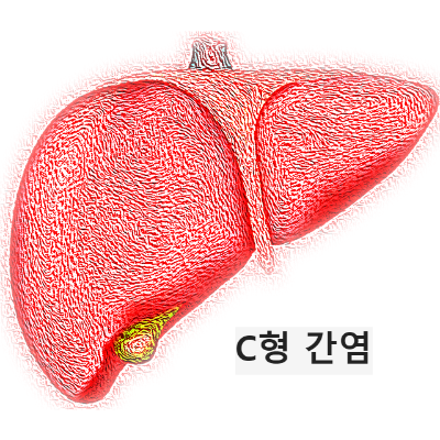 C형 간염