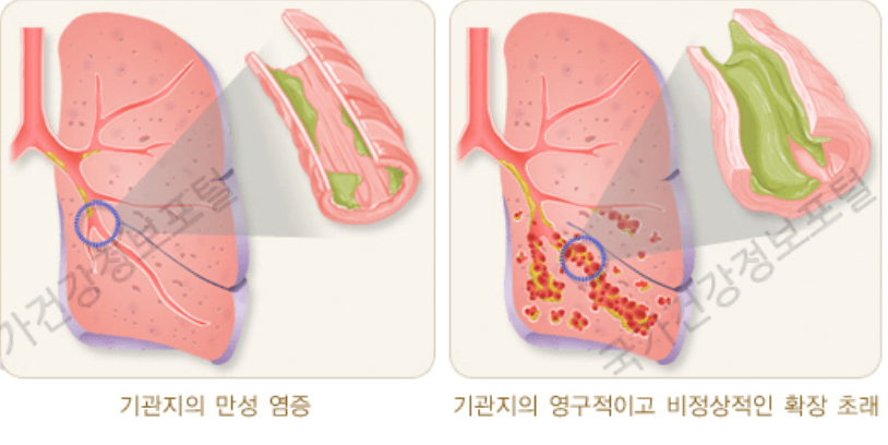 기관지-확장증-이미지