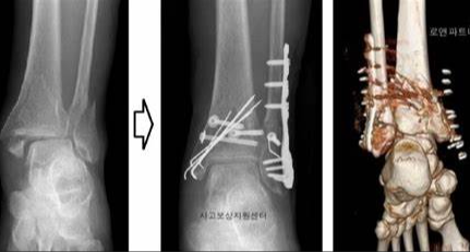 발목 골절 수술