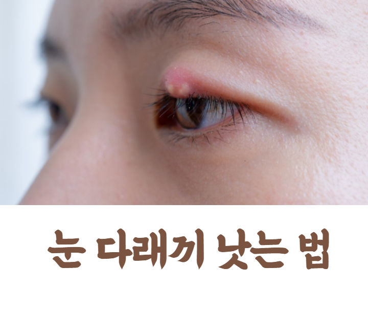  눈 다래끼 원인 및 빨리 낫는 방법