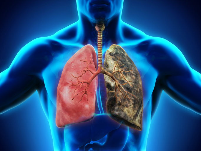 COPD, 만성폐쇄성폐질환