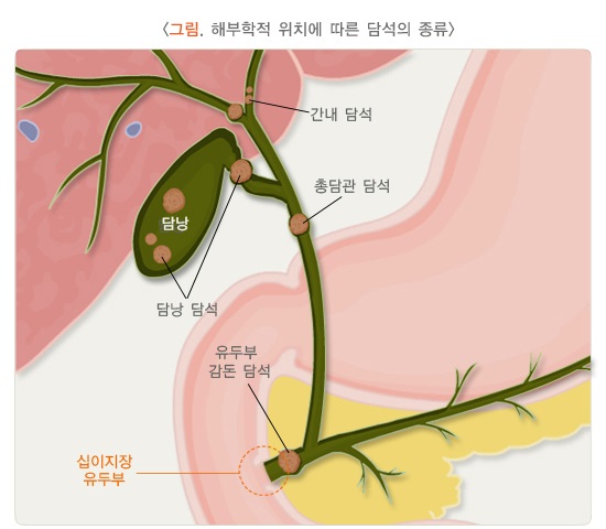 담낭의-해부학적-위치에-따른-담석-종류