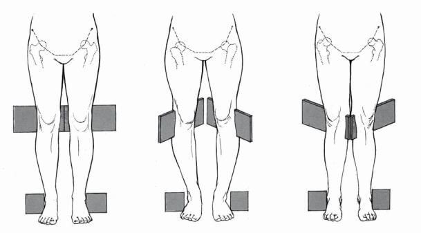 무릎과 발의 모양을 보여주는 그림으로 정상과 내반슬&#44; 외반슬의 나타낸 그림