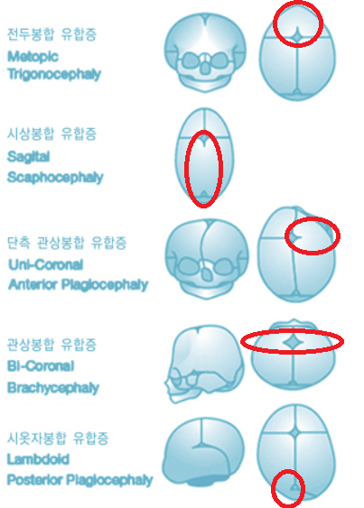 두개골 조기 유합 위치에 따른 머리 모양 변형