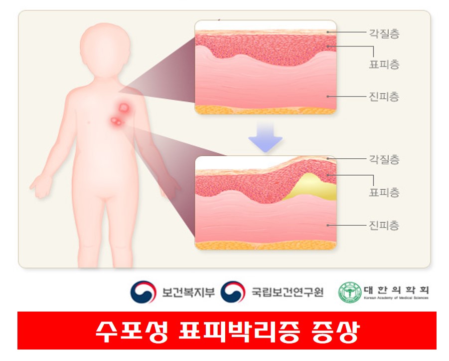 수포성 표피박리증 증상 보건복지부 자료 사진