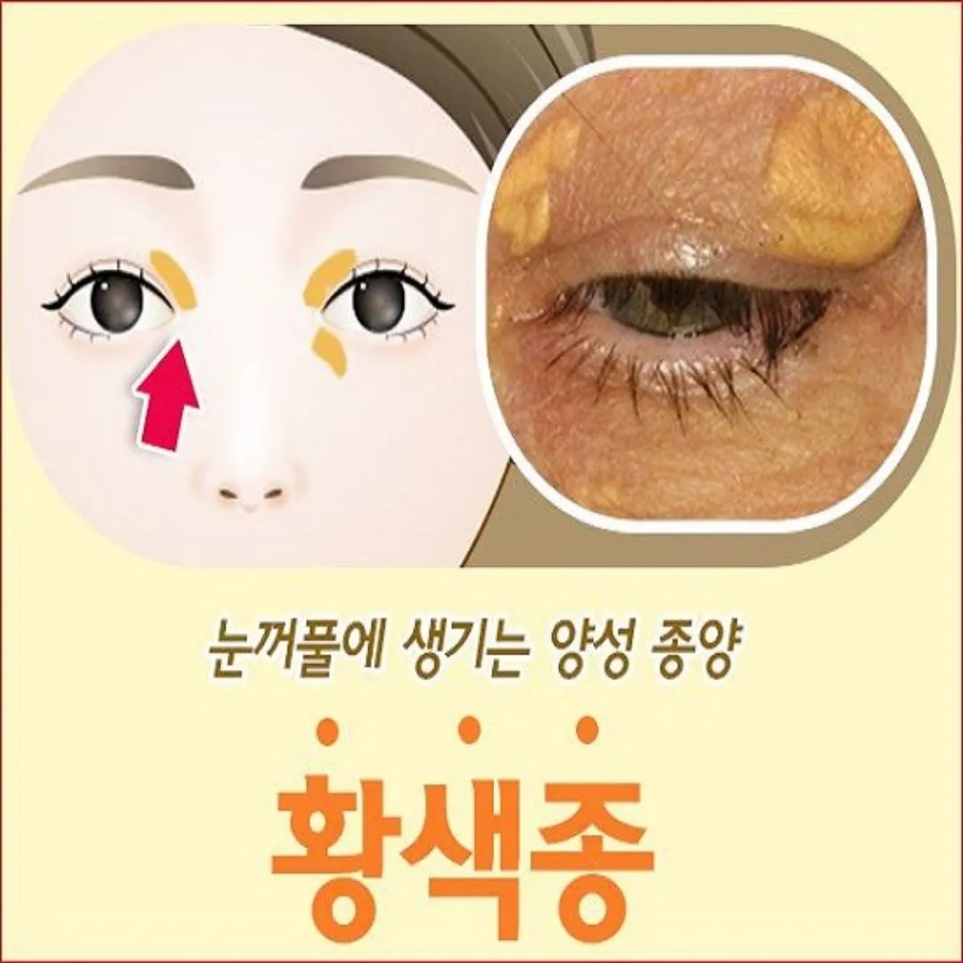 고지혈증 증상과 원인