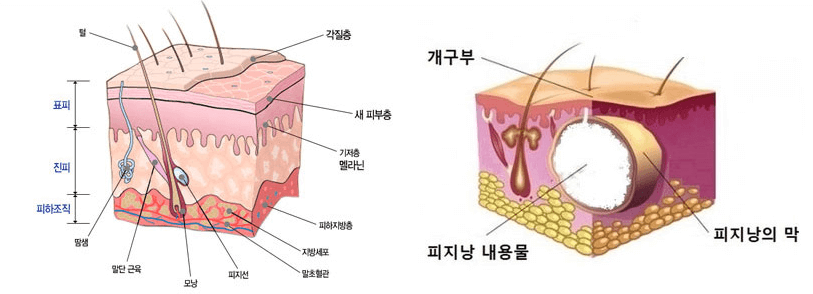 표피(피지) 낭종