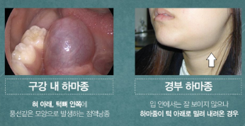 입안 점액 낭종 원인 및 치료법