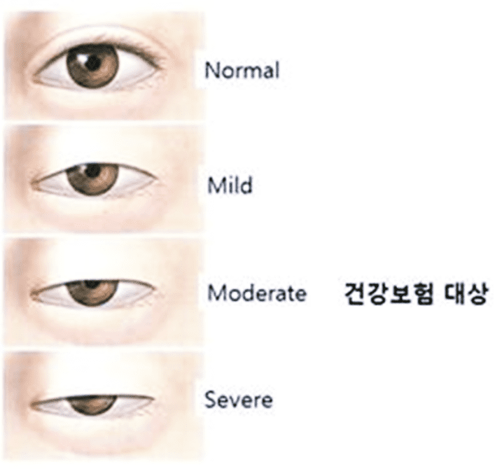 안검하수 정도에 따른 보험적용 