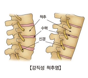 강직성 척추염 증상