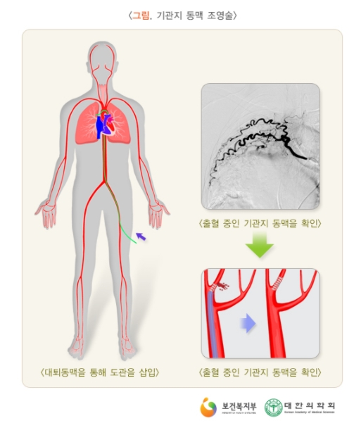 각혈2