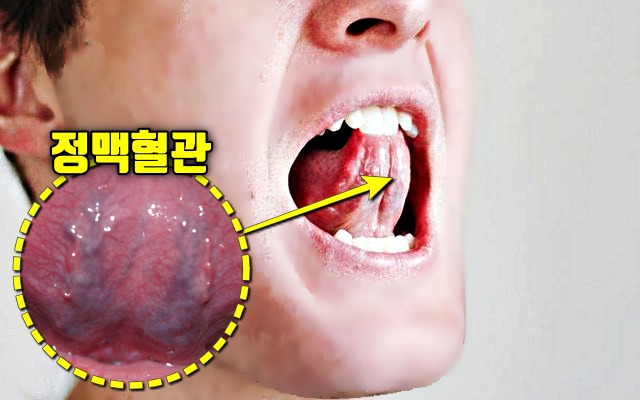 혀 아래 정맥 돌연사 전조증상 혀 이상증세