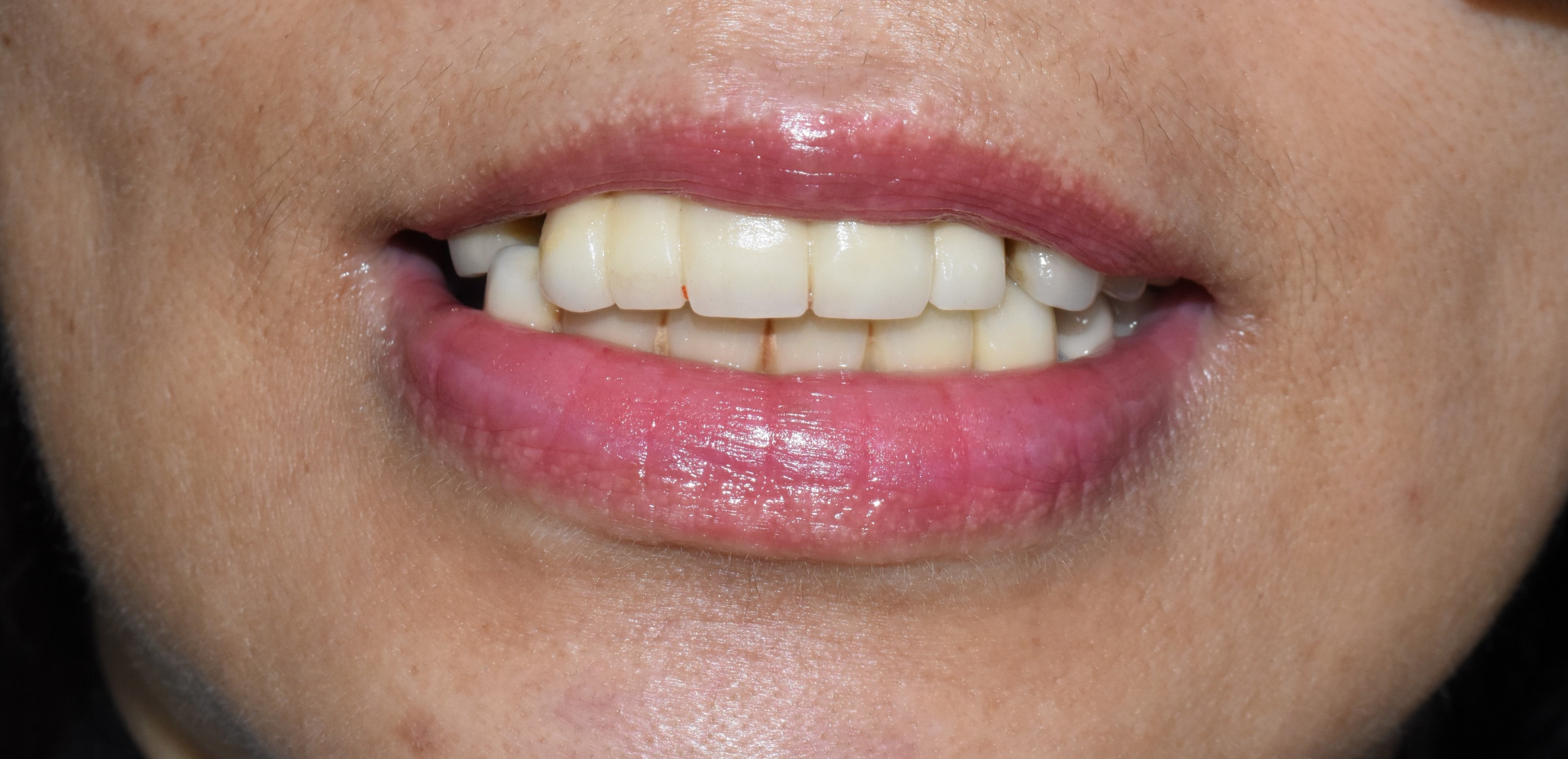 Hong Kong Patient’s Journey to FullMouth Implants in Seoul, South Korea