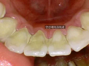 스케일링 후 양치 통증 음식_5