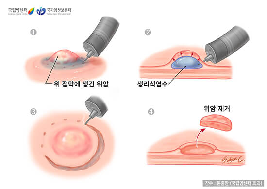 내시경 점막절제술 (출처 : 국가암정보센터)