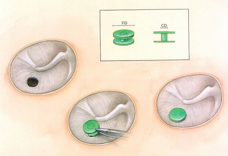 고막 천공의 치료