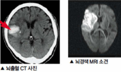 뇌경색 이미지