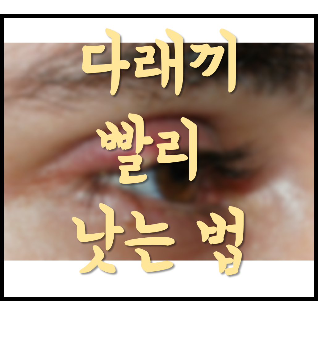  [생활의지혜] 보기싫게 퉁퉁부은 눈 다래끼 빨리 낫는 법! 당장 효과보기