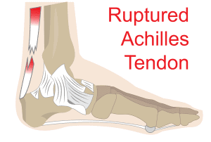 아킬레스건 파열