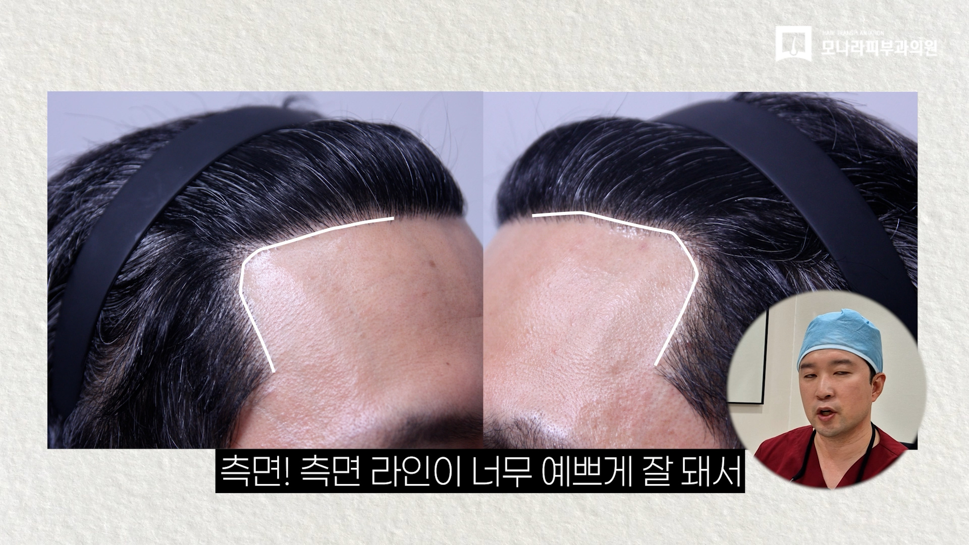 강남 헤어라인 문신 실패 후 모발이식으로 커버