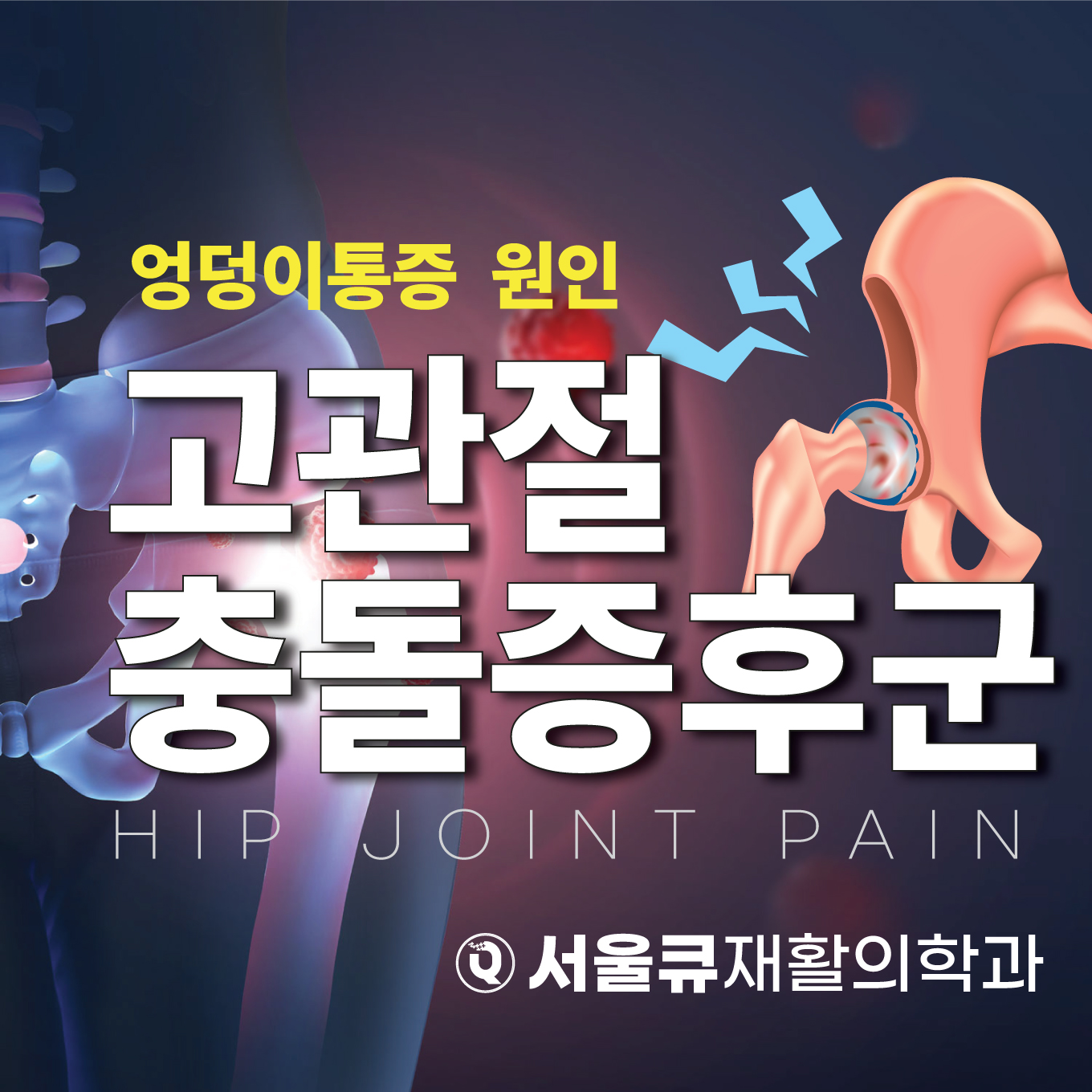  잠실통증의학과, 고관절충돌증후군 엉덩이 통증의 원인