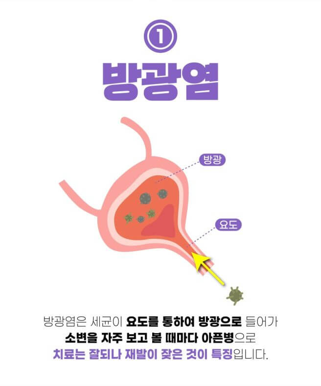 방광염 증상