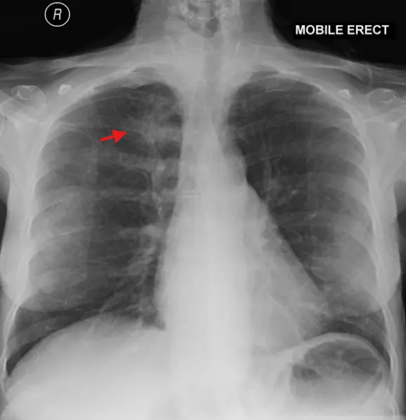 lung adenocarcinoma의 xray소견
