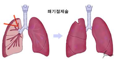 쐐기절제술