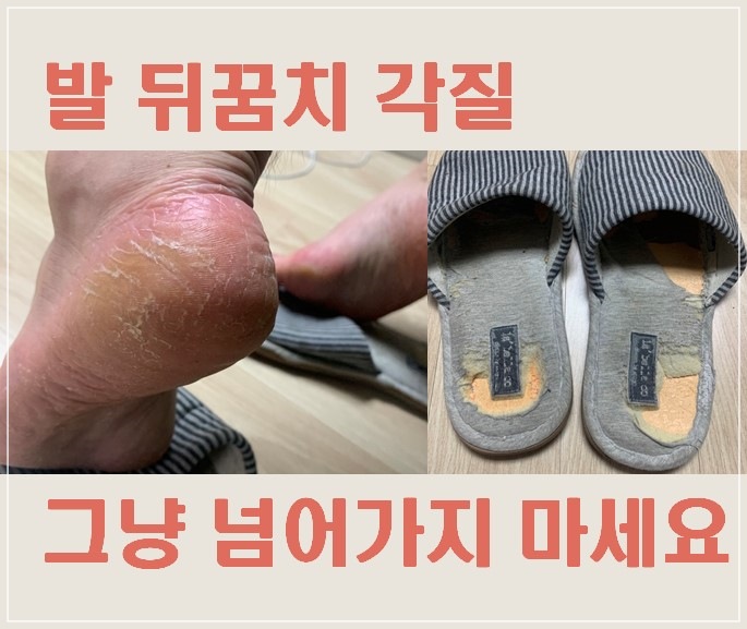  각화형 무좀 원인, 빠른 치료 방법, 약