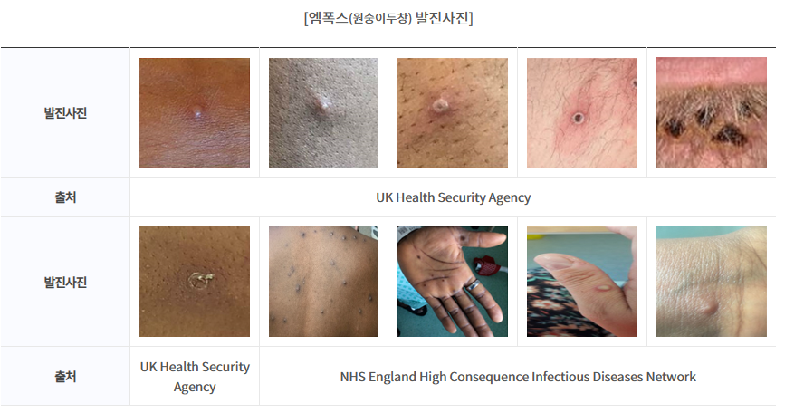 Mpox 발진 사진