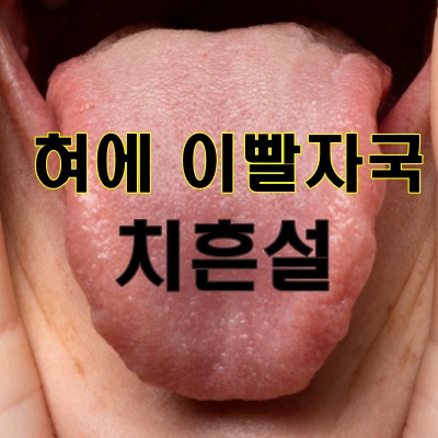 치흔설