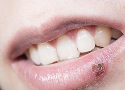 남성의 헤르페스 2형