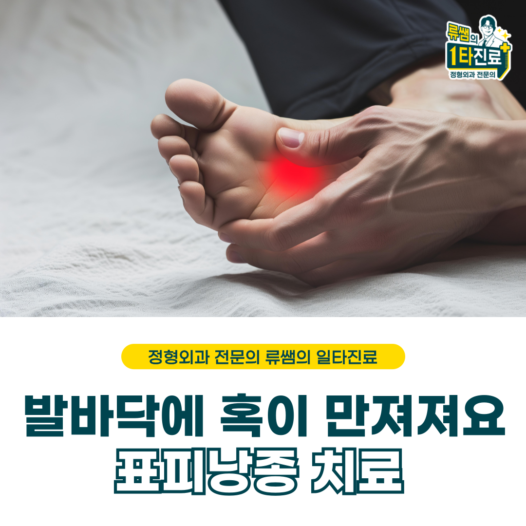  발바닥 혹/ 표피 낭종 치료 및 관리