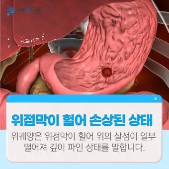 식후 속쓰림 원인 해결법 총정리_24