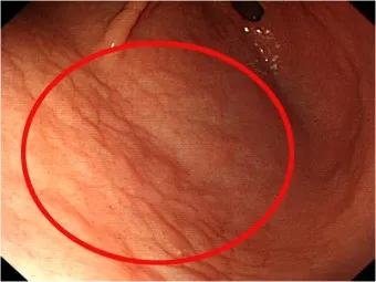 헬리코박터균 제균 치료 치료방법 성공률_17