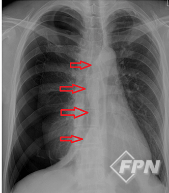 기흉 환자 폐 X-RAY 이미지