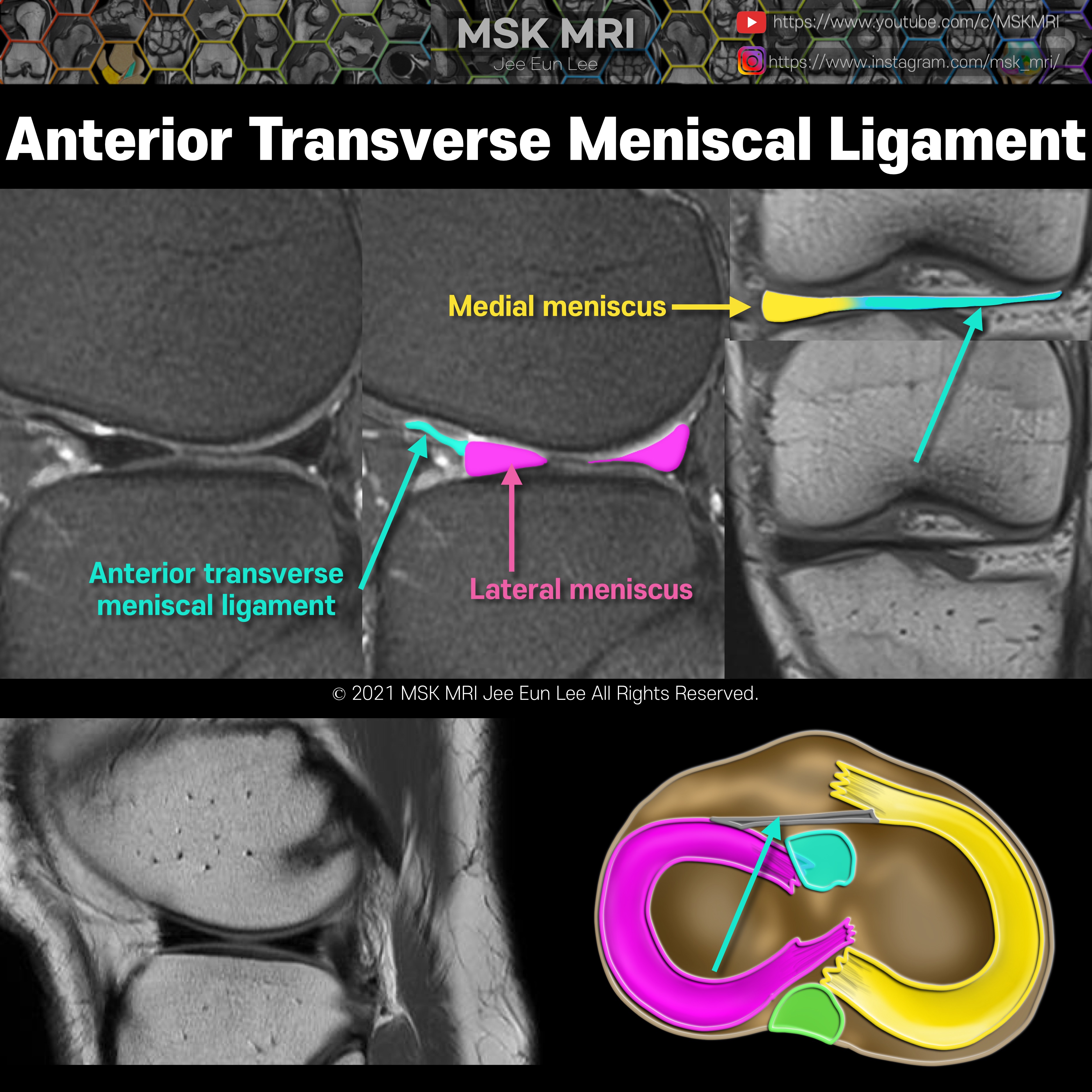 transverse ligament of the knee