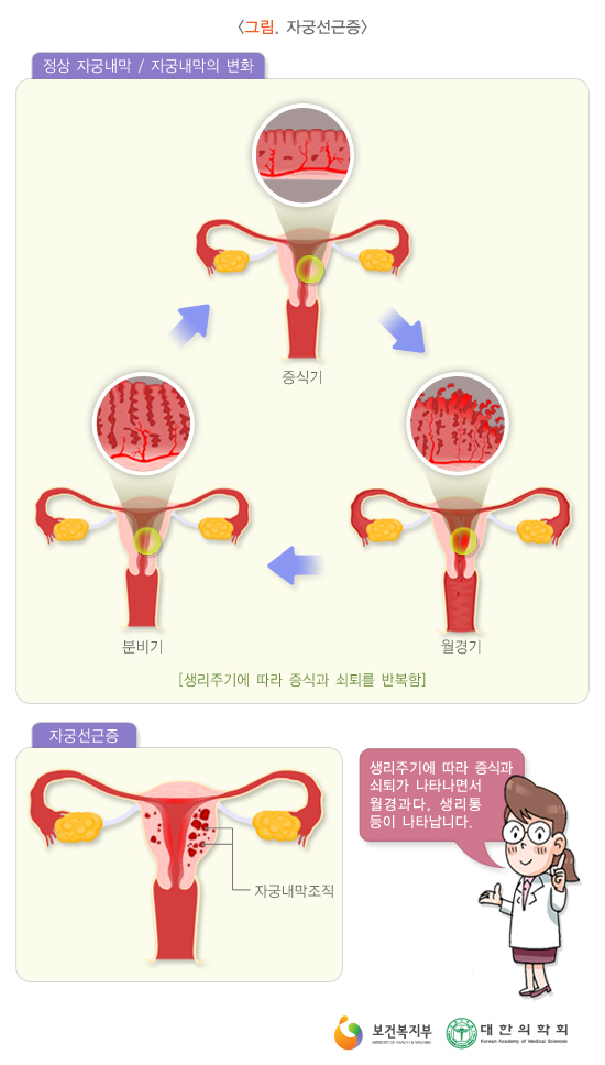속발성 생리통의 원인 (광주 여수 광양 순천 자궁내막증 자궁선근증 자궁근종 한방치료 아이앤맘 한의원) 속발성 생리통의 원인 (광주 여수 광양 순천 자궁내막증 자궁선근증 자궁근종 한방치료 아이앤맘 한의원)