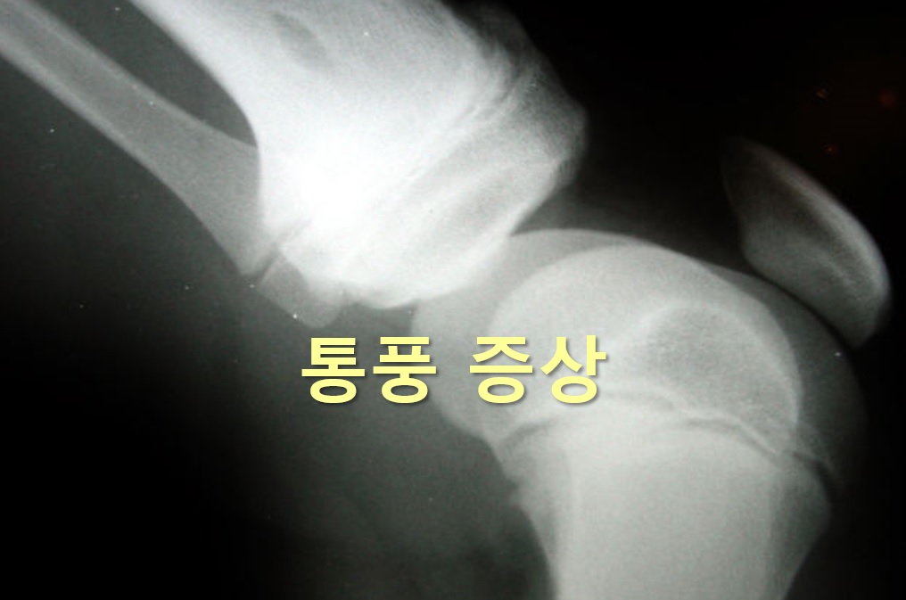  통풍 증상과 진단과 치료를 위한 통풍 진료과 안내
