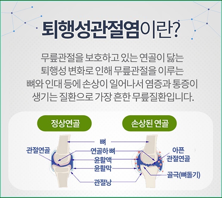  퇴행성 관절염이란?