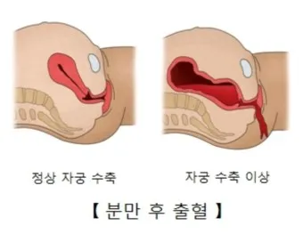 출산 후 자궁수축 기간_29