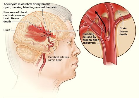 뇌동맥류 증상