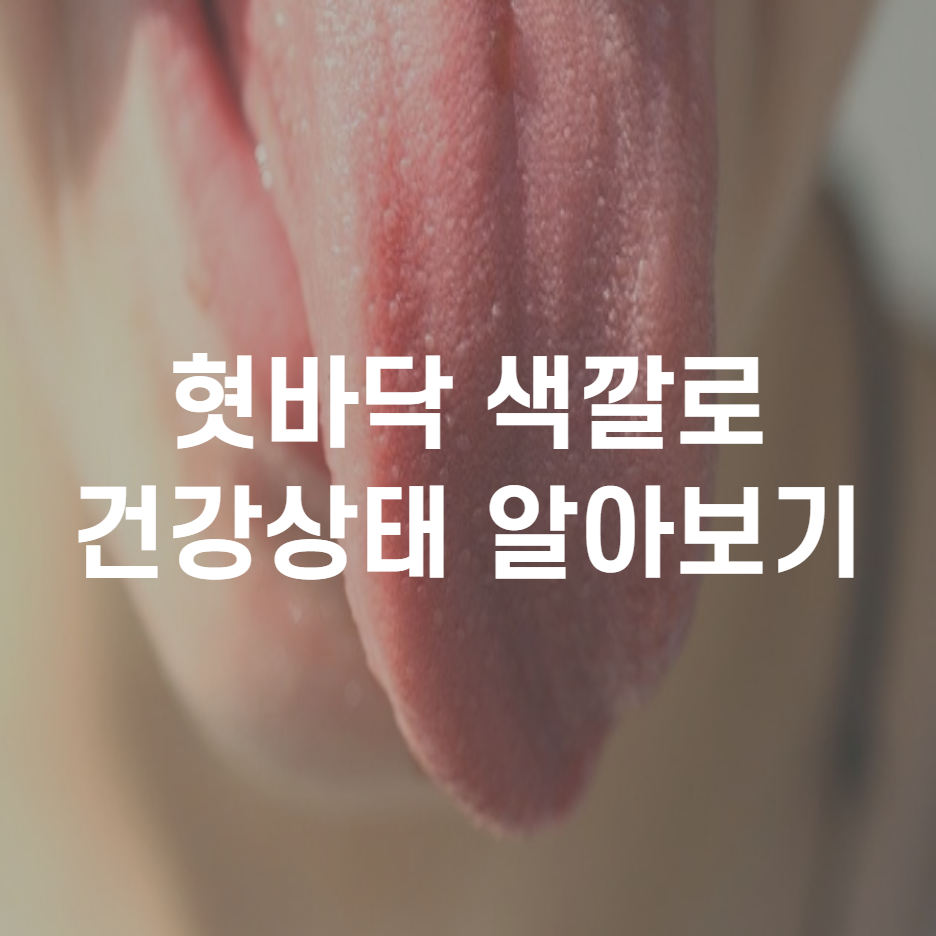  혀 백태 원인과 제거법 혓바닥 색깔로 알아보는 건강상태