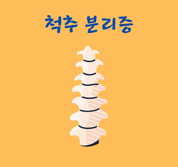  척추 분리증이란