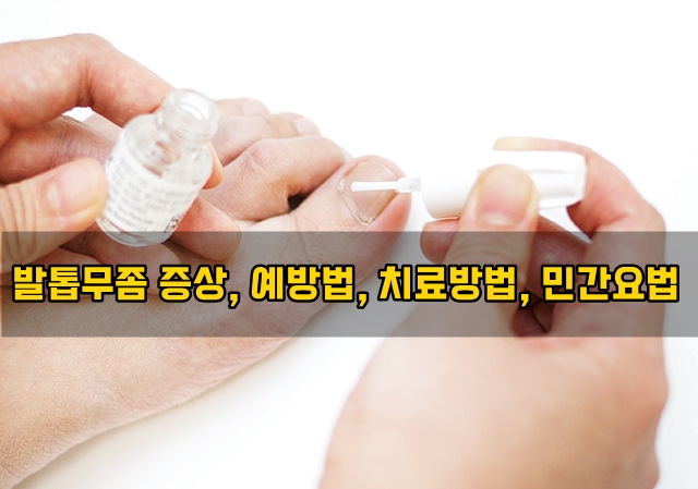  발톱무좀 증상, 예방법, 치료방법, 민간요법