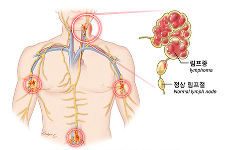 [Roche] 컬럼비 (Columvi)