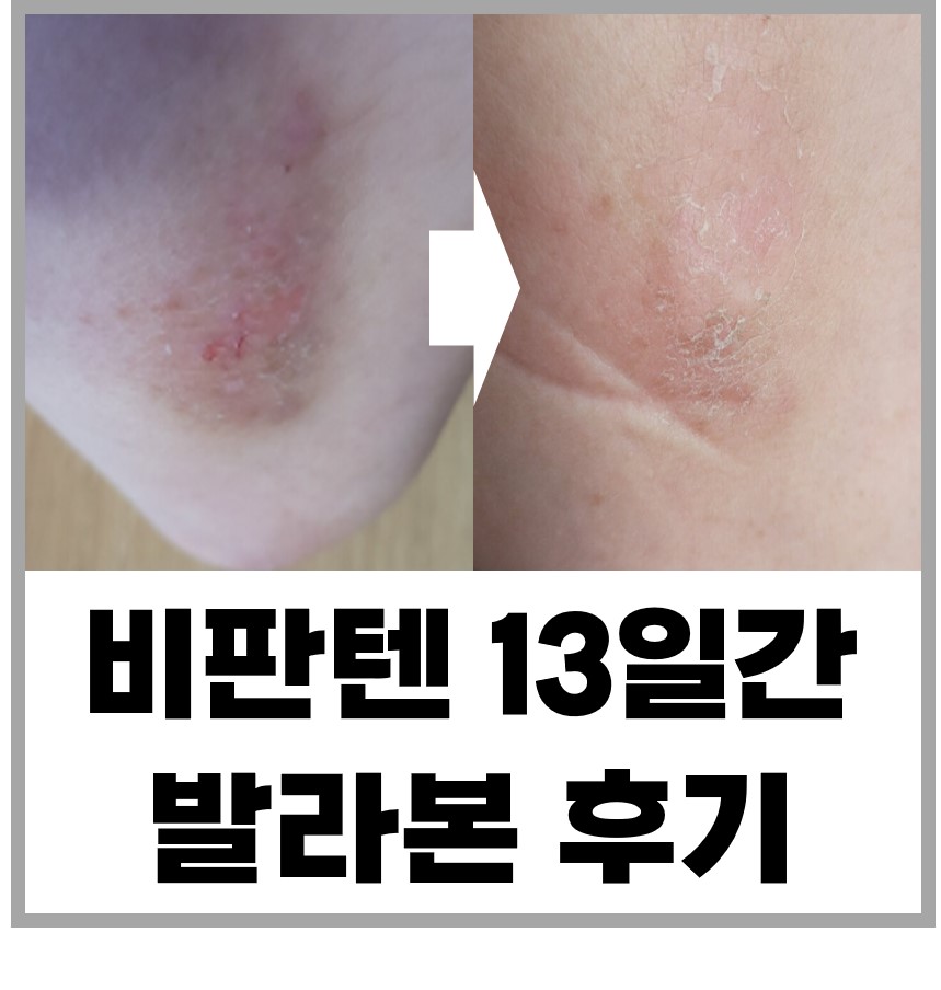  비판텐 연고 13일간 바른 후기와 가격, 안티셉틱 차이