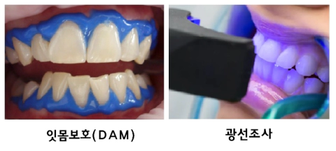 전문가 미백 술식 사진