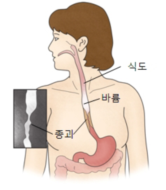 바륨 삼킴 검사 (식도조영술)