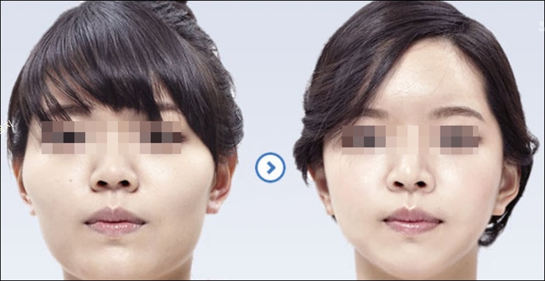 광대뼈 작아지는법 (옆 광대) 광대뼈 작아지는법 (옆 광대)